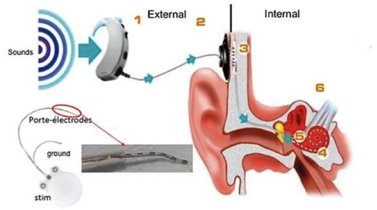 Figure 75&nbsp;: Représentation schématique des différentes composantes d’un implant cochléaire. La partie externe est composée d’un processeur audio, qui enregistre les sons de l’environnement et d’une antenne. La partie interne est constituée d’un stimulateur et d’un porte-électrode de 8 à 22 contacts insérés dans la cochlée.